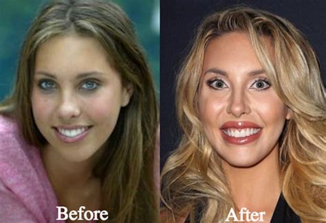 chloe lattanzi before plastic surgery.